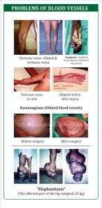 Problems of blood vessels